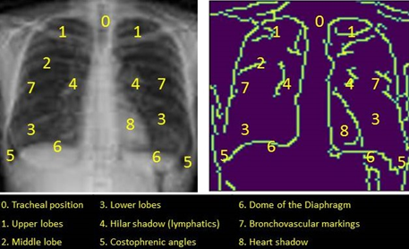 A Novel Approach to Detect Abnormal Chest X-rays of COVID-19 Patients Using Image Processing and Deep Learning